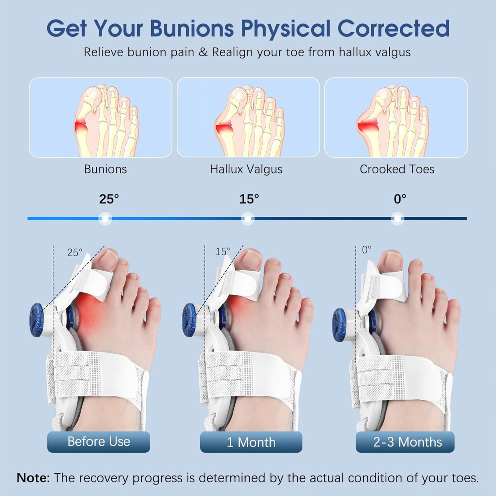 مصحح إبهام القدم القابل للتعديل للنساء والرجال - الصورة 3
